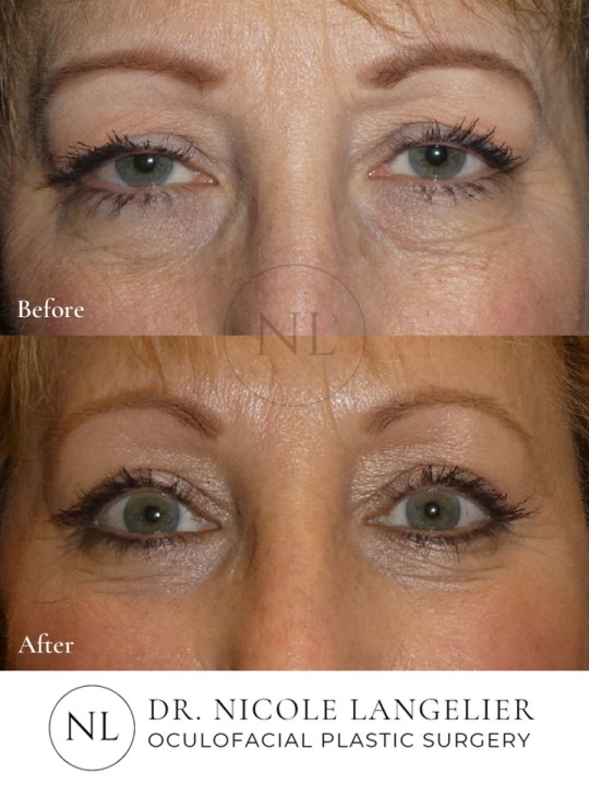 Female Lower Eyelid Blepharoplasty