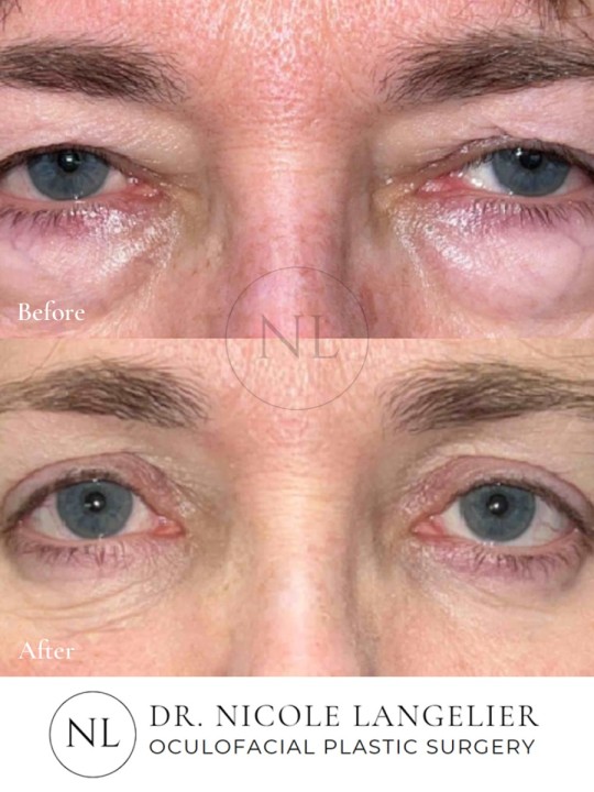 Female Lower Eyelid Blepharoplasty