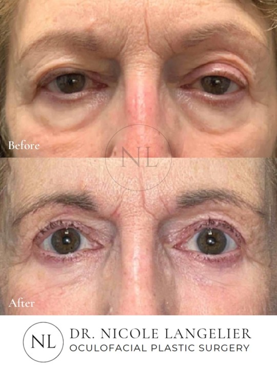 Female Lower Eyelid Blepharoplasty