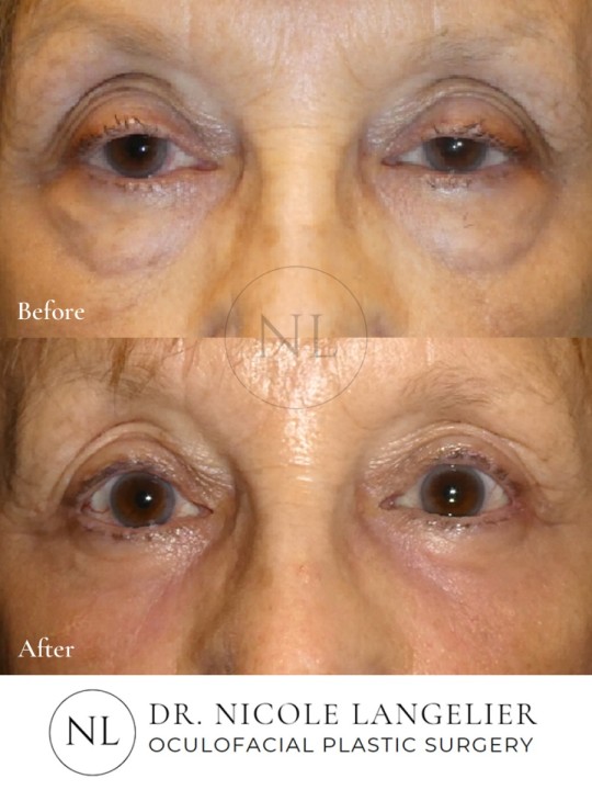 Female Lower Eyelid Blepharoplasty