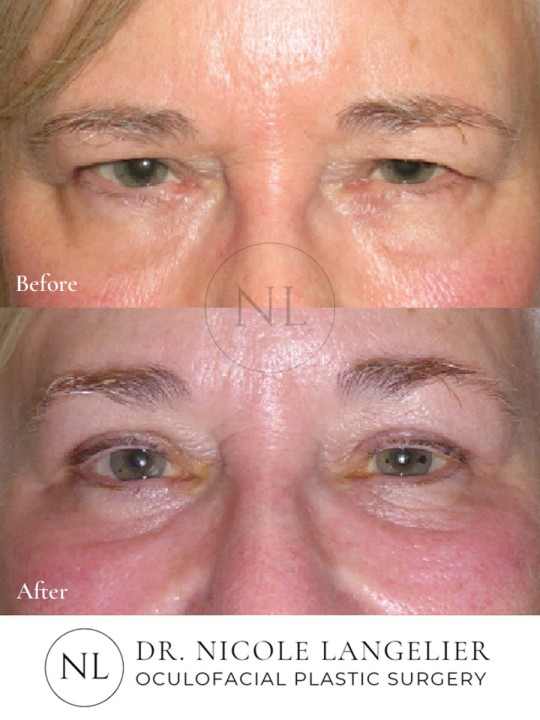 Female Lower Eyelid Blepharoplasty