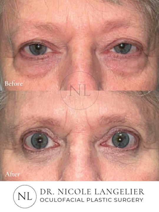 Female Lower Eyelid Blepharoplasty