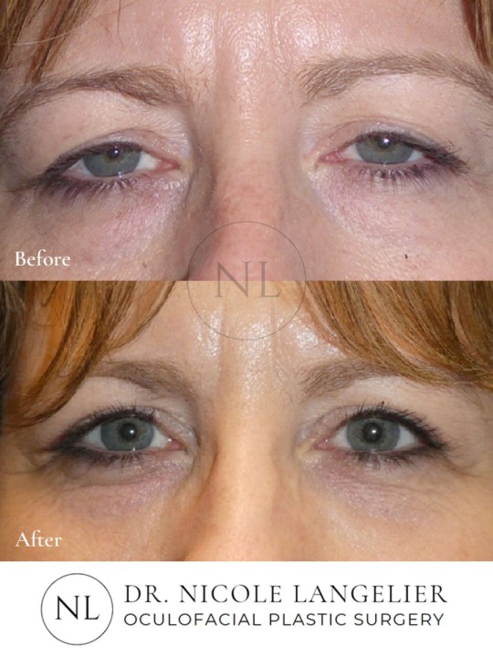 Female Lower Eyelid Blepharoplasty
