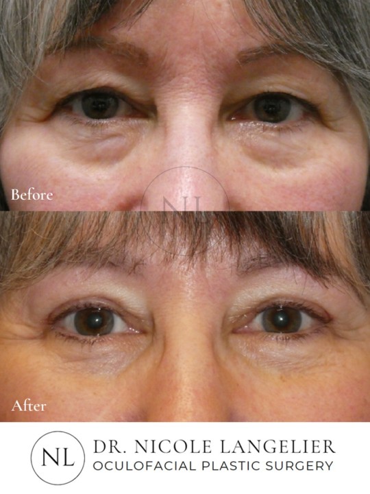 Female Lower Eyelid Blepharoplasty