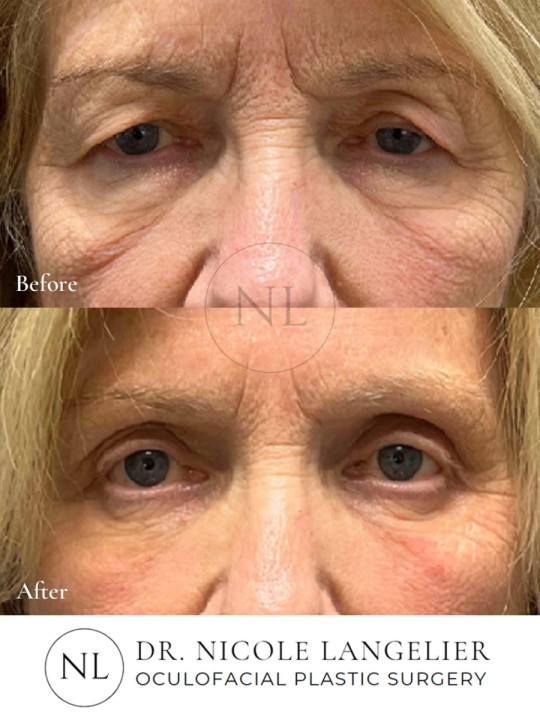 Female Lower Eyelid Blepharoplasty