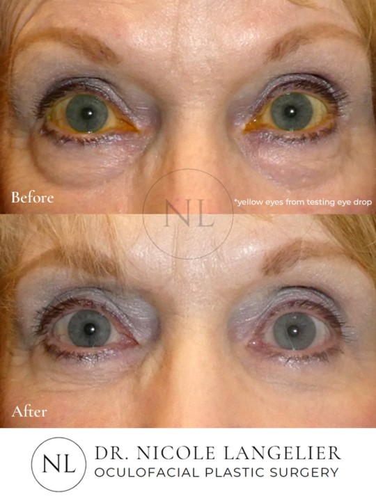 Female Lower Eyelid Blepharoplasty