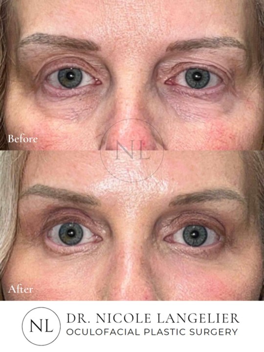 Lower Eyelid Blepharoplasty with Fat Transposition