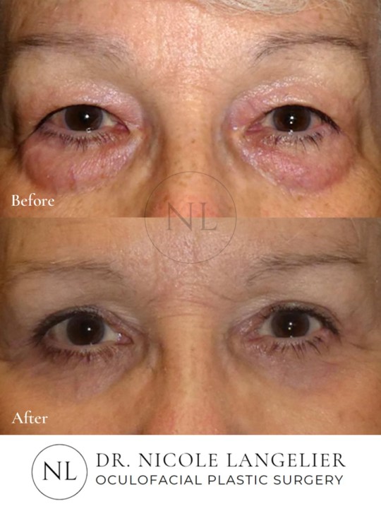 Female Lower Eyelid Blepharoplasty