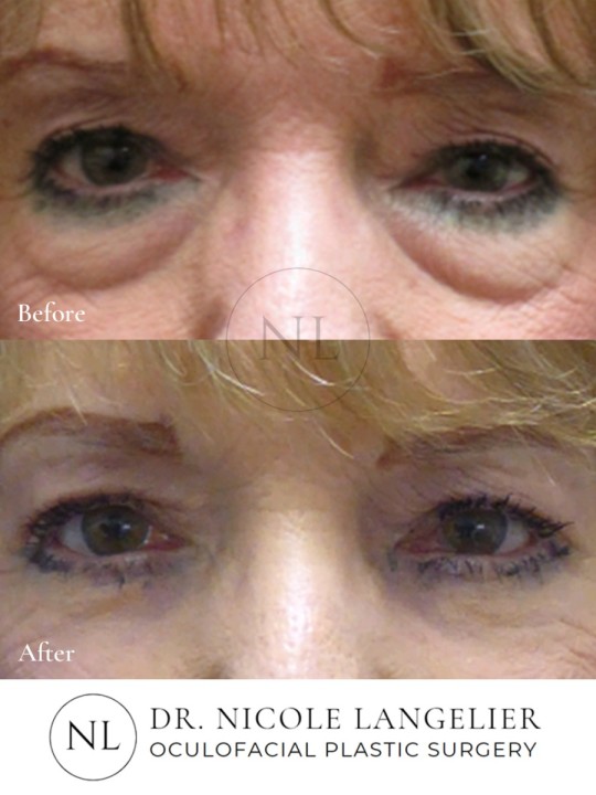 Female Lower Eyelid Blepharoplasty