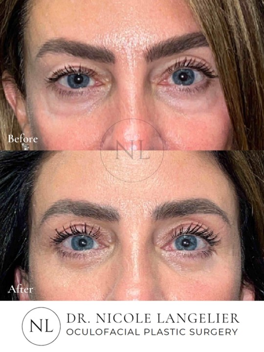 Female Lower Eyelid Blepharoplasty