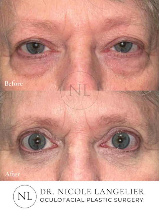 Female Lower Eyelid Blepharoplasty