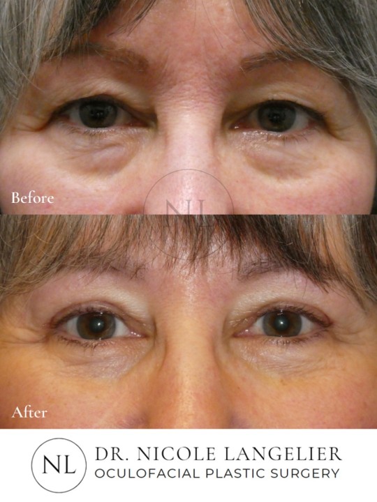 Female Lower Eyelid Blepharoplasty