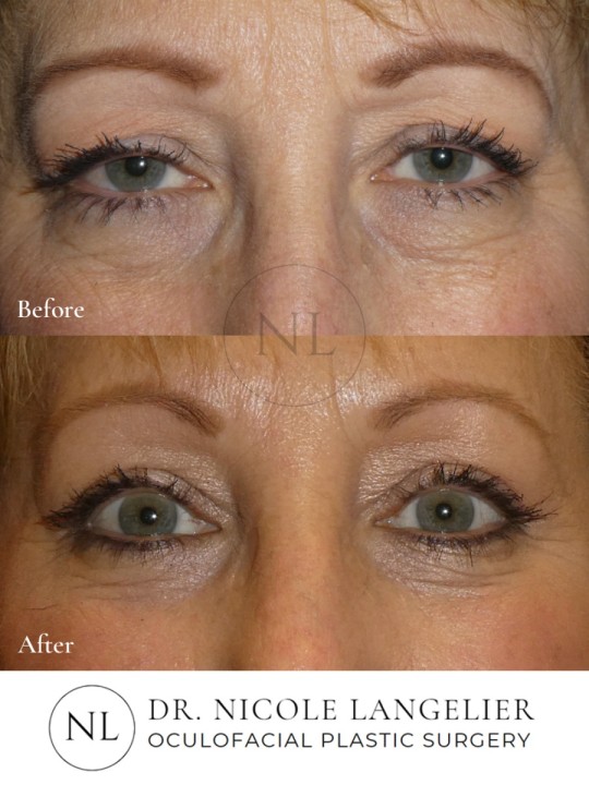 Female Lower Eyelid Blepharoplasty