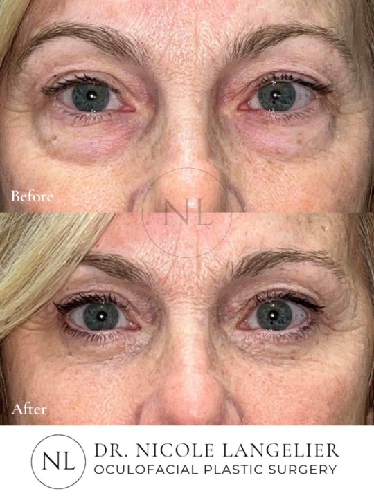 Female Lower Eyelid Blepharoplasty