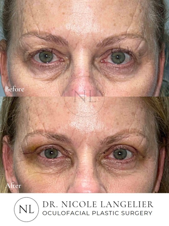 Female Upper Eyelid Blepharoplasty