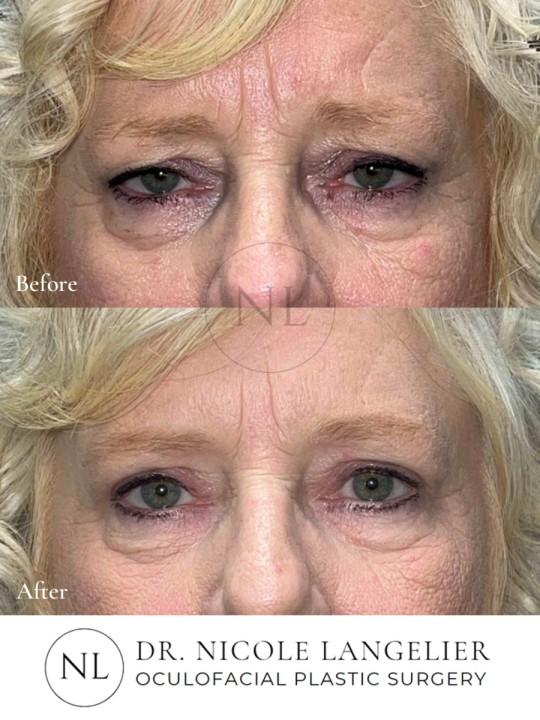Female Upper Eyelid Blepharoplasty