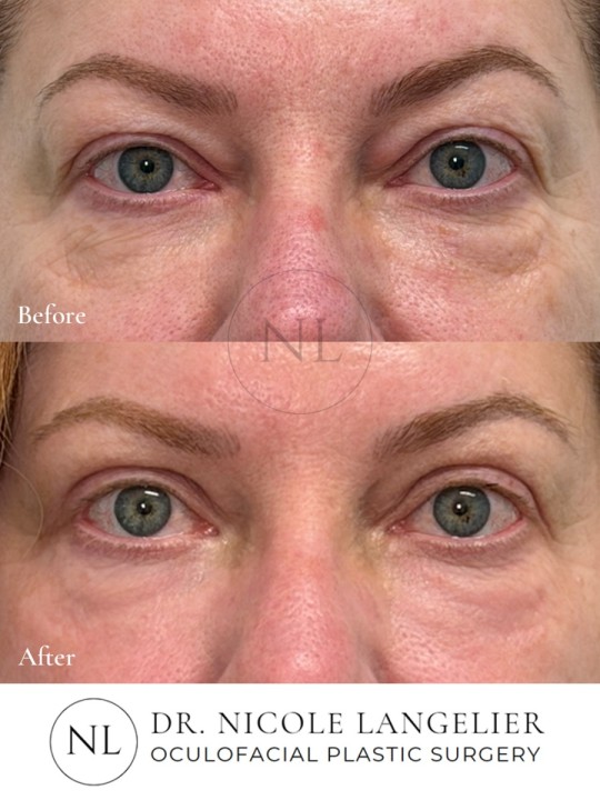 Female Upper Eyelid Blepharoplasty