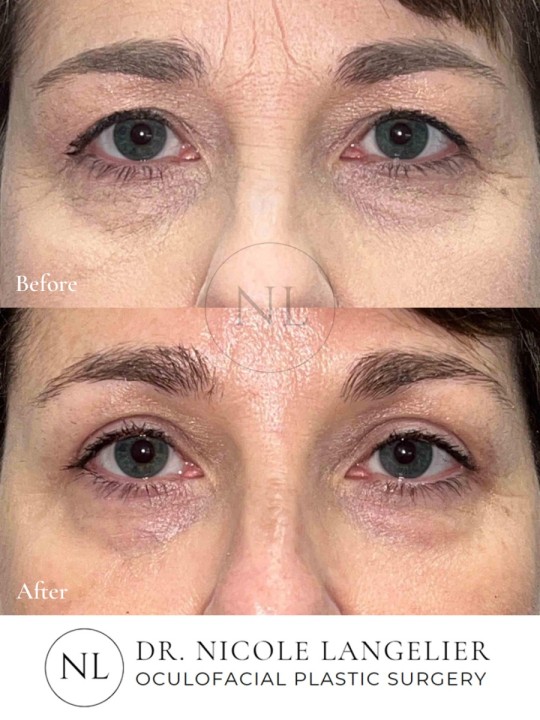 Female Upper Eyelid Blepharoplasty