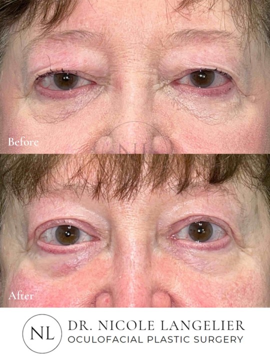 Female Upper Eyelid Blepharoplasty