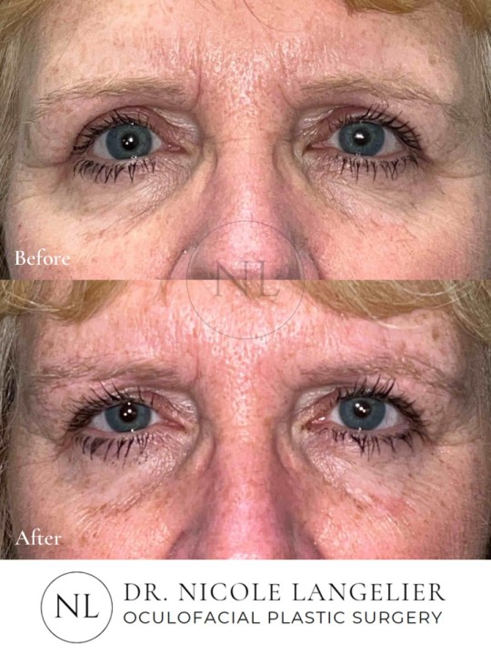 Female Upper Eyelid Blepharoplasty