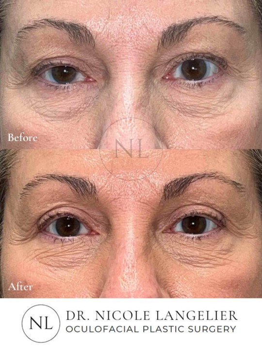Female Upper Eyelid Blepharoplasty