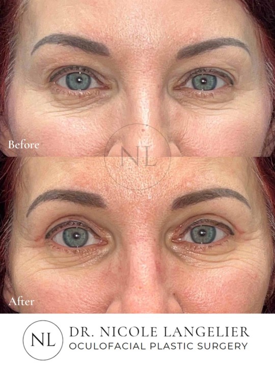 Female Upper Eyelid Blepharoplasty