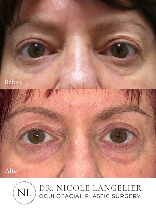 Female Upper Eyelid Blepharoplasty