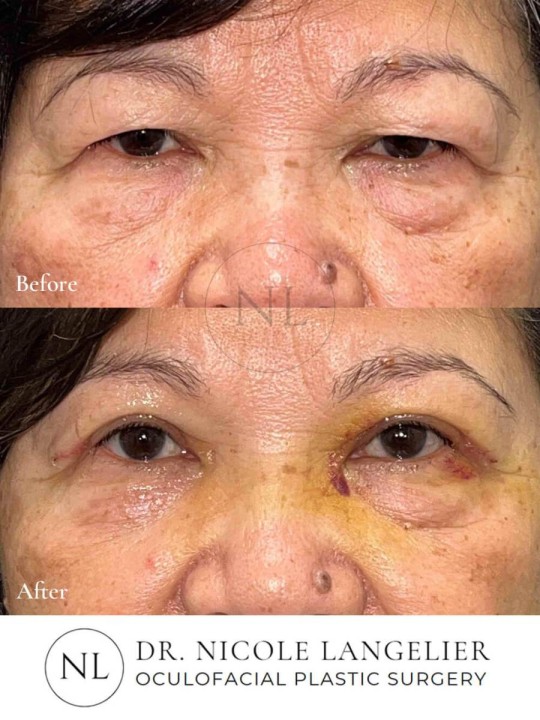 Female Upper Eyelid Blepharoplasty