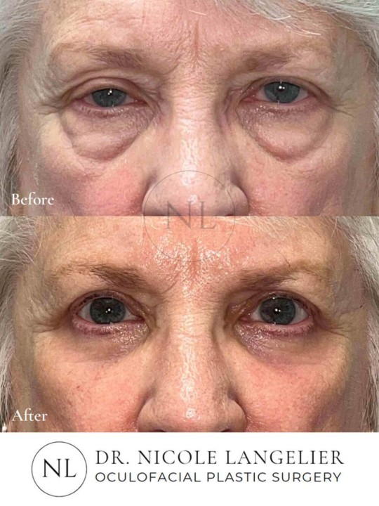 Female Upper Eyelid Blepharoplasty