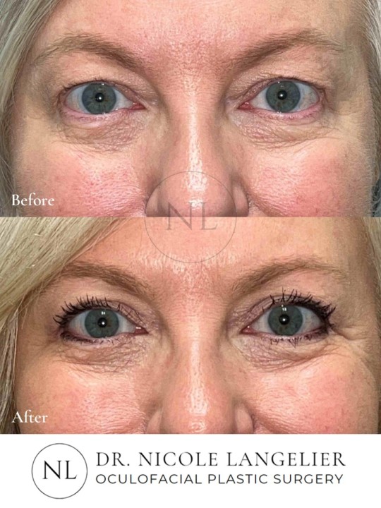 Female Upper Eyelid Blepharoplasty