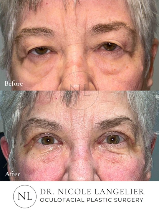 Female Upper Eyelid Blepharoplasty