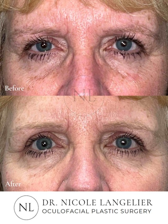 Female Upper Eyelid Blepharoplasty