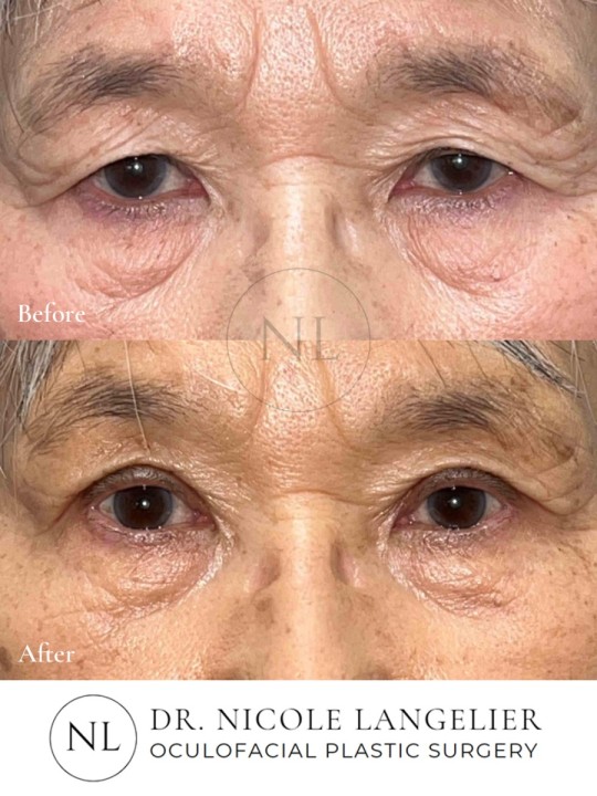 Female Upper Eyelid Blepharoplasty