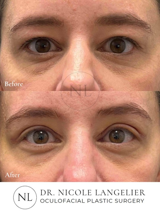 Female Upper Eyelid Blepharoplasty