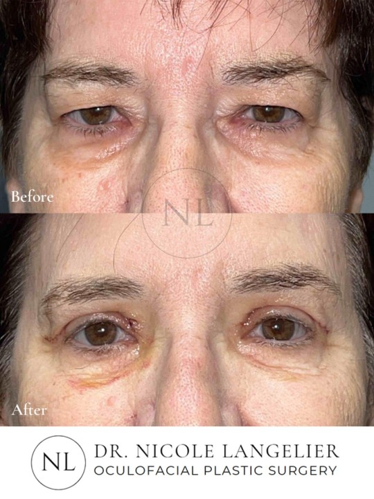 Female Upper Eyelid Blepharoplasty