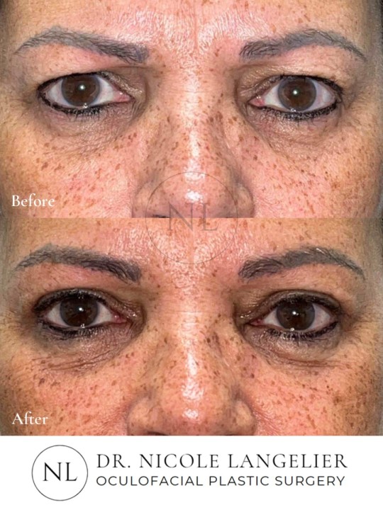 Female Upper Eyelid Blepharoplasty