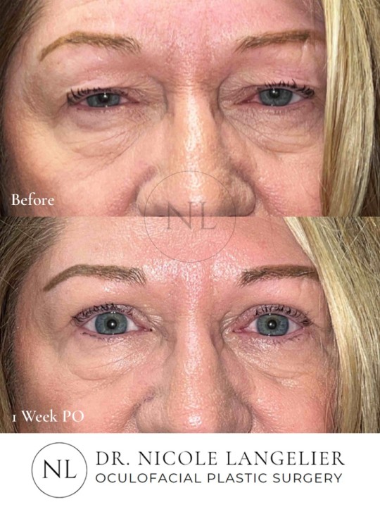 Female Upper Eyelid Blepharoplasty