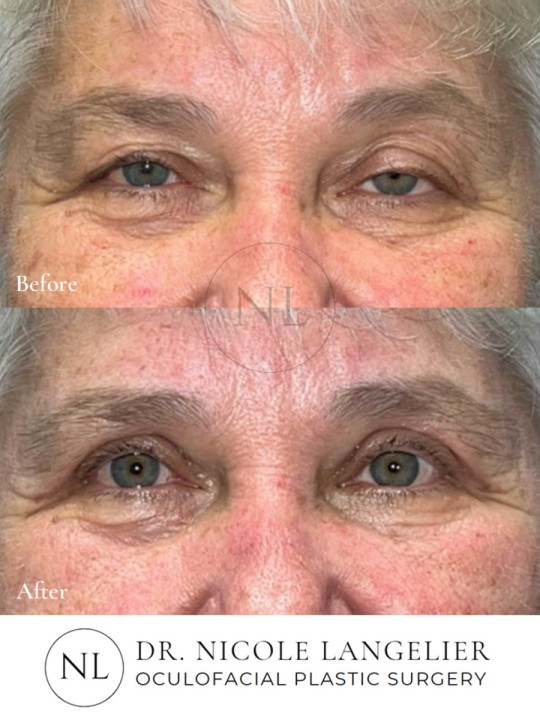 Female Upper Eyelid Blepharoplasty