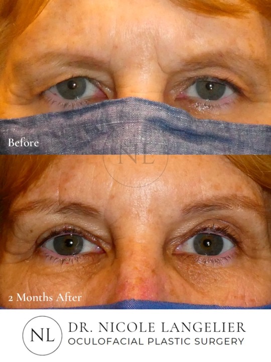Left Upper Eyelid Cosmetic Blepharoplasty