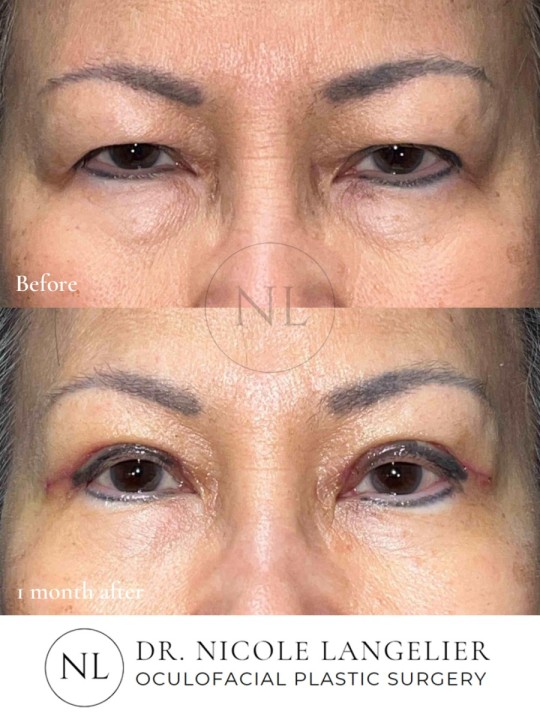 Female Upper Eyelid Blepharoplasty