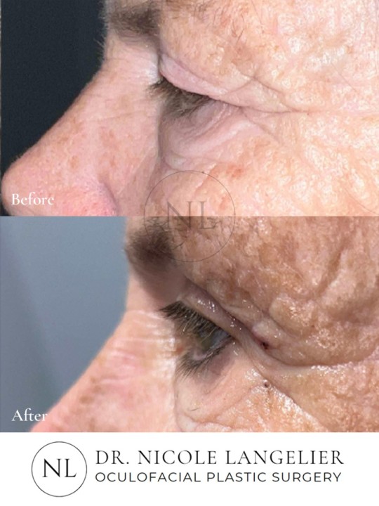 Upper Eyelid Blepharoplasty Side view 1 week post op