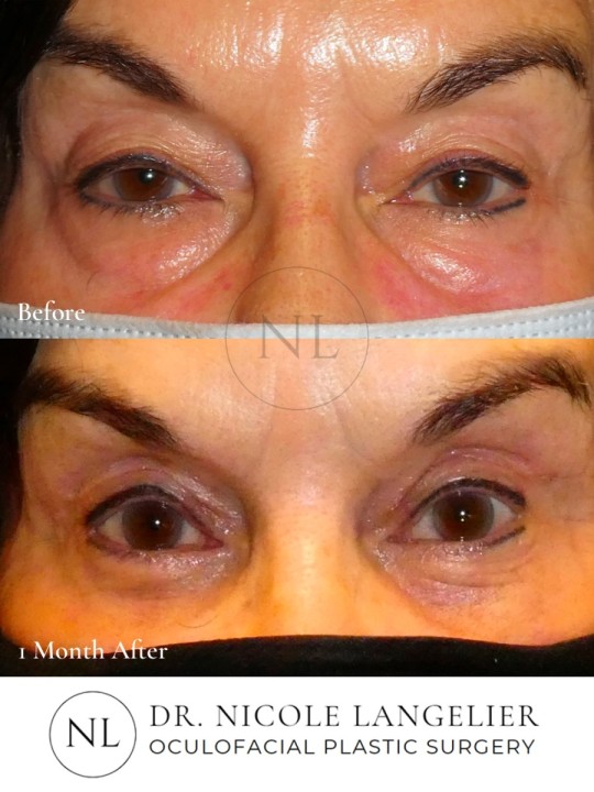 Female Upper Eyelid Blepharoplasty