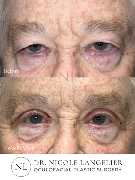 Female Upper Eyelid Blepharoplasty