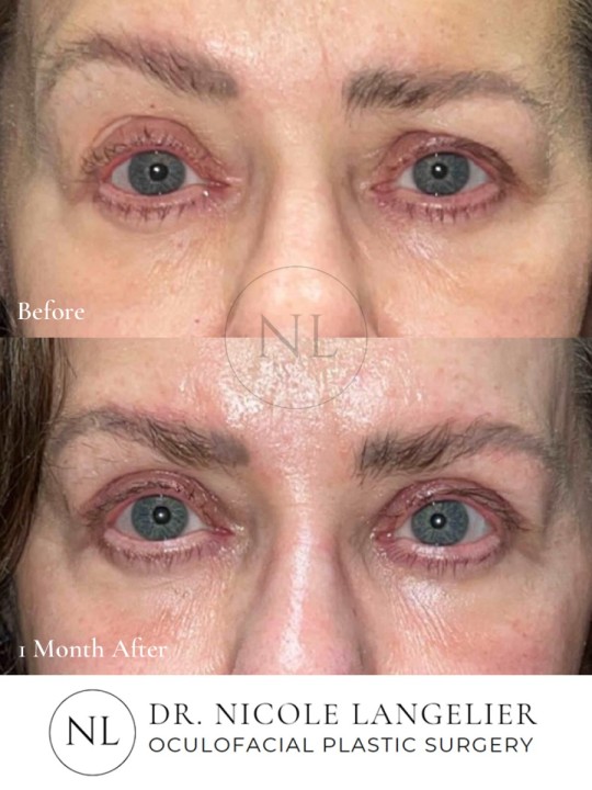 Female Upper Eyelid Blepharoplasty