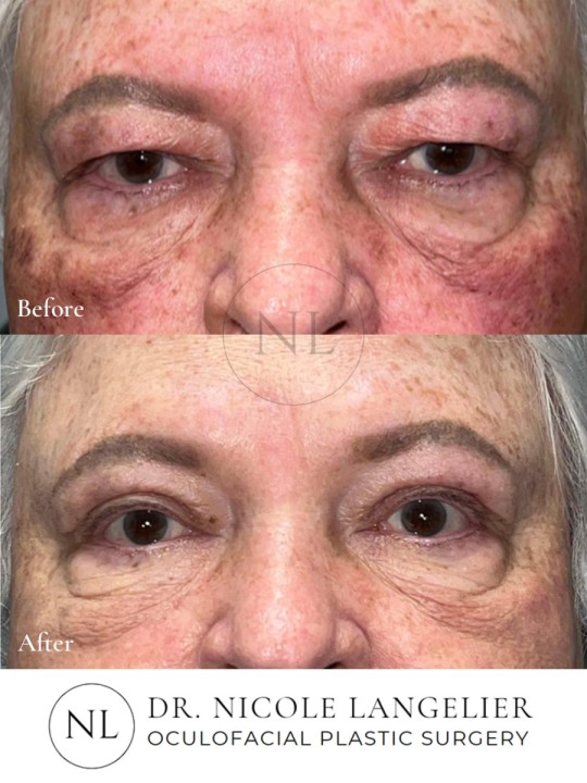 Female Upper Eyelid Blepharoplasty