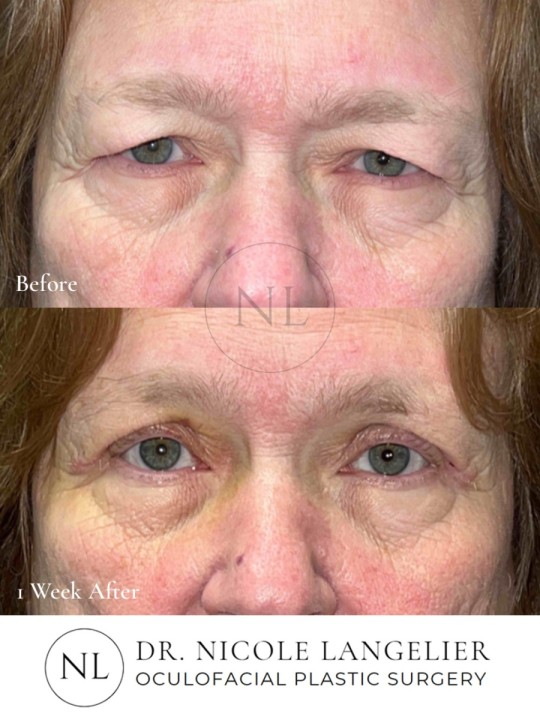 Female Upper Eyelid Blepharoplasty