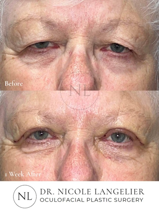 Female Upper Eyelid Blepharoplasty