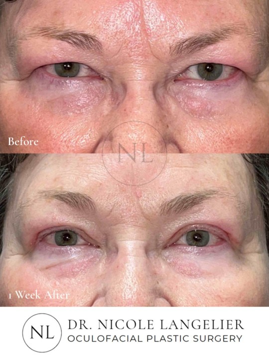 Female Upper Eyelid Blepharoplasty