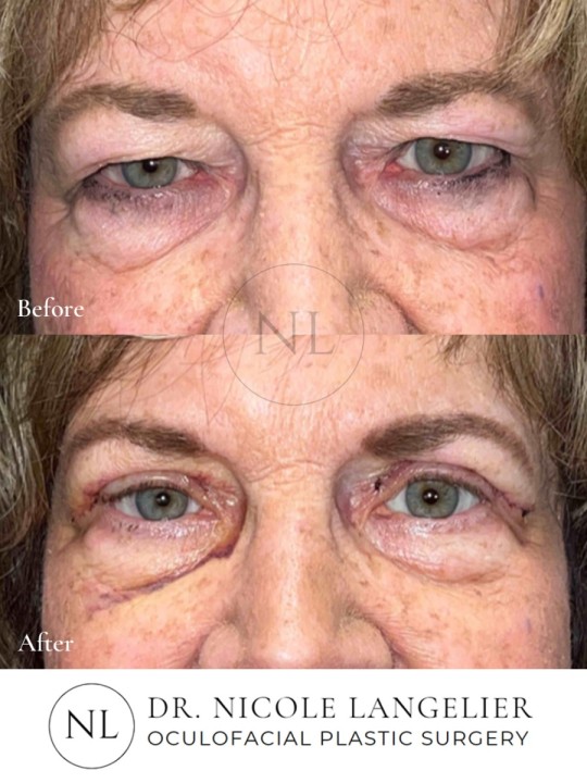 Female Upper Eyelid Blepharoplasty