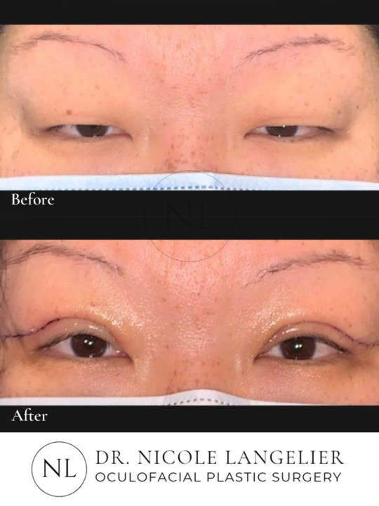 Upper Eyelid Blepharoplasty- crease formation